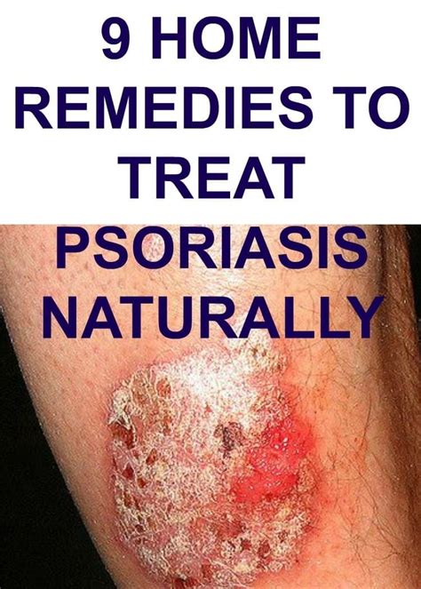 9 Home Remedies To Treat Psoriasis Naturally Treat Psoriasis Plaque