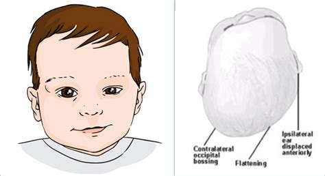 Flat Head Syndrome Medical Grade Baby Pillow Flat Head Mimos