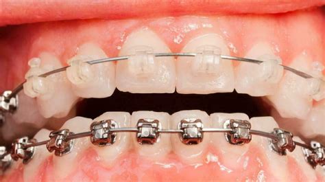 Metal Braces Or Ceramic Braces Which Ones To Choose
