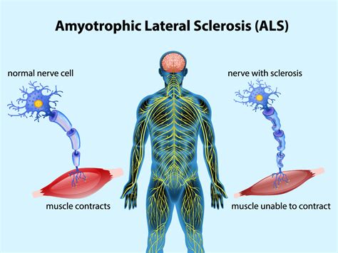 Amyotrophic Lateral Sclerosis Als Understanding The Progression And