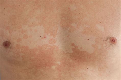 Slsi Lk How Long For Sulfatrim To Work Can What Is The Best Treatment For Pityriasis