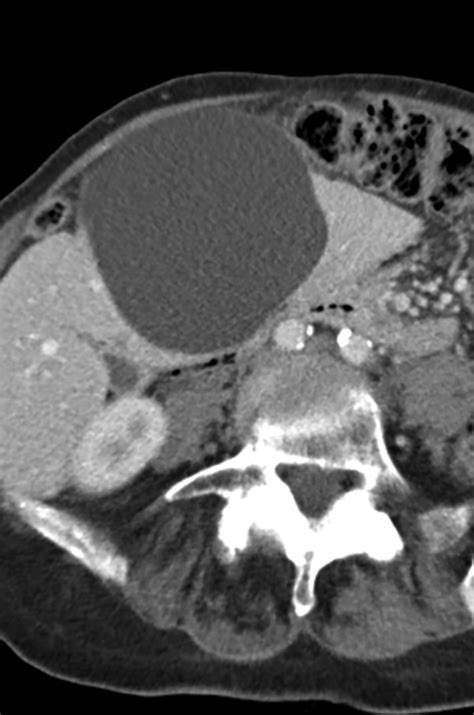 Hepatic Mucinous Cystic Neoplasm Versus Simple Biliary Cyst Assessment