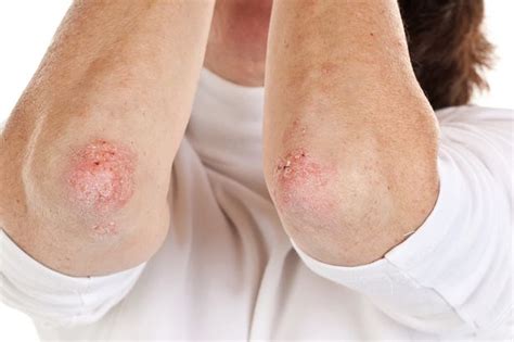 What Is Psorasis Top Tips To Help Soothe The Painful Skin Condition