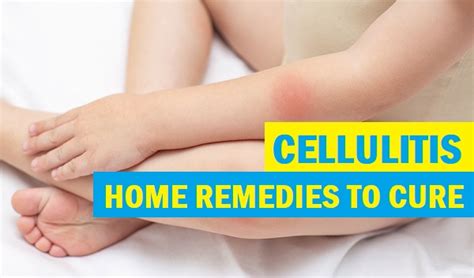 Try 25 Natural Remedies For Cellulitis Treatment At Home And Effective