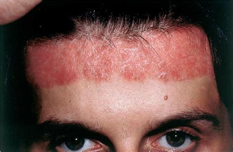 Psoriatic Lesions On The Forehead Due To A Tightly Fitting Safety