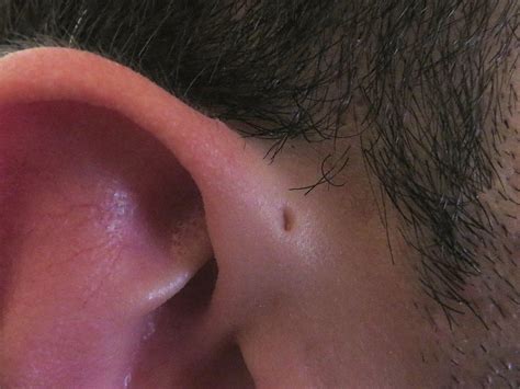Preauricular Sinus And Cyst Wikipedia Ear Sinusitis Cysts