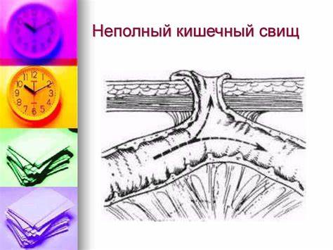 Кишечный свищ диета Свищи пищеворительного тракта - online presentation Свищи пищеворительного тракта - online presentation Кишечный свищ диета