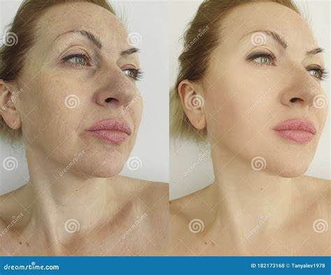 Woman Face Wrinkles Before And After Double Chin Treatment Stock Photo