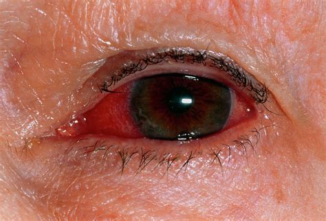 Die symptome aller formen von konjunktivitis sind ähnlich, aber wir werden ihnen sagen. Close-up Of Eye With Viral Conjunctivitis Photograph by Dr ...