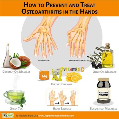How To Prevent And Treat Osteoarthritis In The Hands Top 10 Home