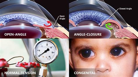 Glaucoma What Are Causes Symptoms Prevention And Cure