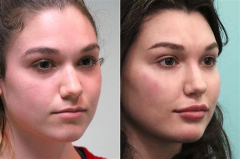 Cheeks Midface Injections Injections Laser Treatments Photos Chevy Chase Md Patient