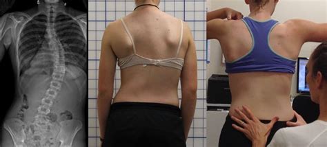 schroth application scoliosis physiotherapy