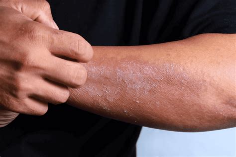 Eczema Treatment Scottsdale And Paradise Valley Skin Care