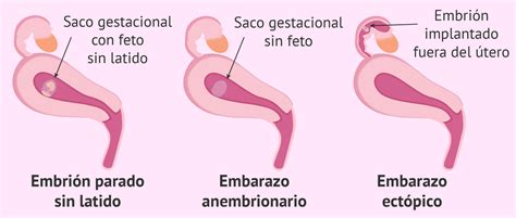 Como Es El Saco Gestacional En Un Aborto Bellota Digital