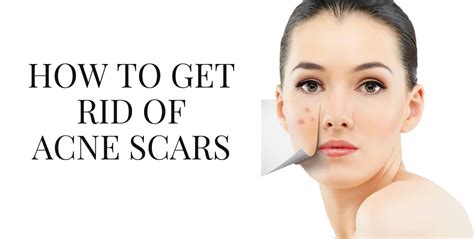 How To Get Rid Of Acne Scars Premier Clinic