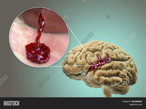 Hemorrhagic Stroke 3d Image And Photo Free Trial Bigstock