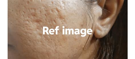Treatment For Deep Pitted Acne Scars Rindianskincareaddicts