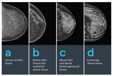 What Having Dense Breasts Means For Your Health Kettering Health