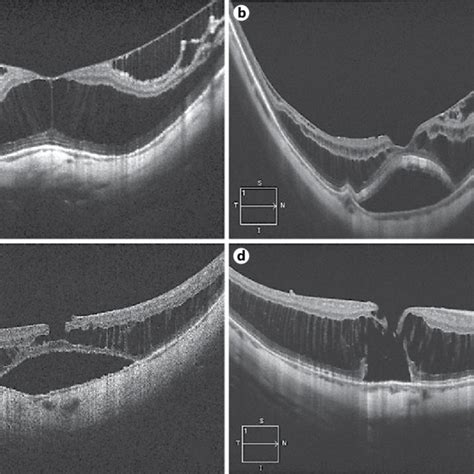 A High Myopia With Posterior Staphyloma B Full Thickness Mh With