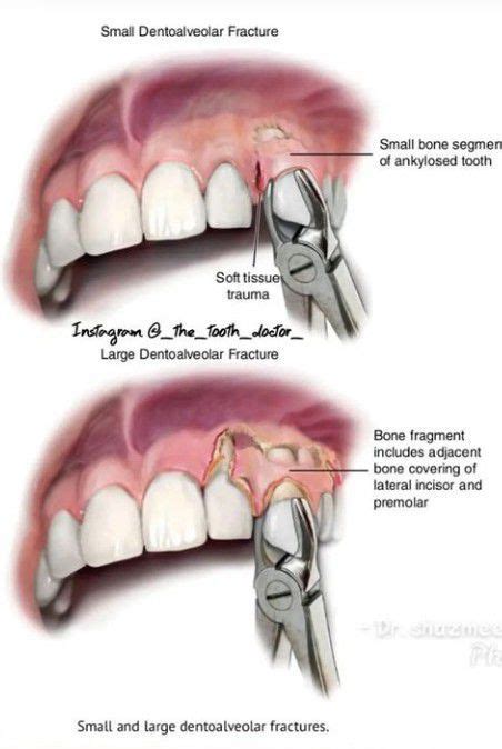 Dentoalveolar Fracture MEDizzy