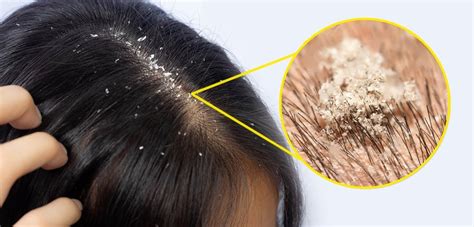 Itchy Scalp How To Prevent And Treatment Az Hair