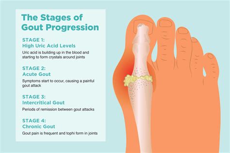 How Long Does Gout In The Ankle Last