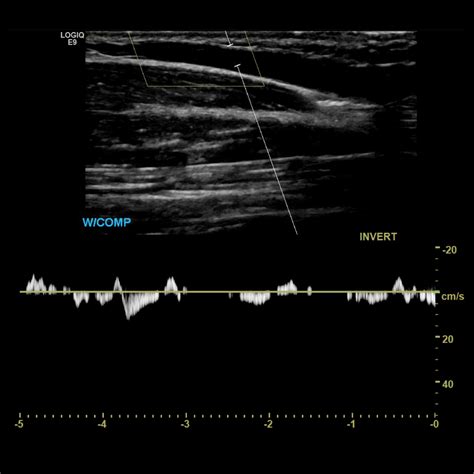 Upper Extremity Venous Doppler Sonographic Tendencies Vascular