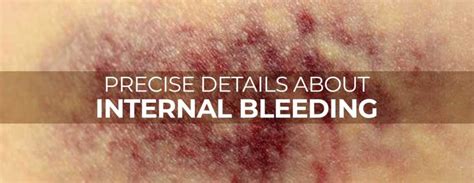Internal Bleeding Symptoms Causes And Treatmentmarham
