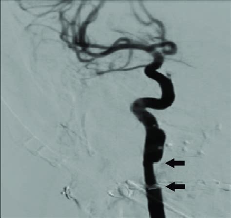 Selective Angiogram Of The Right Internal Carotid Artery Ica Showing