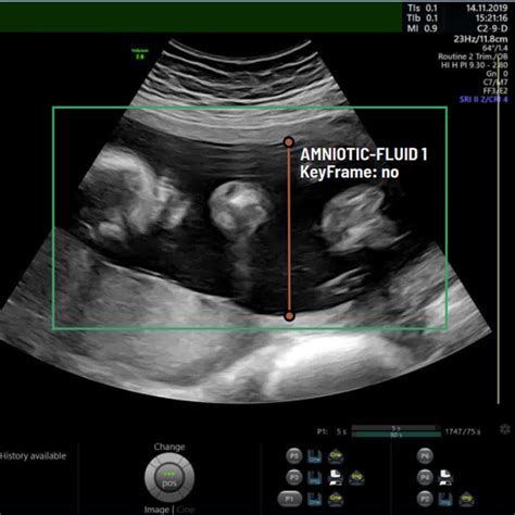 A Afma Ultrasound Challenge Automatic Amniotic Fluid Measurement And