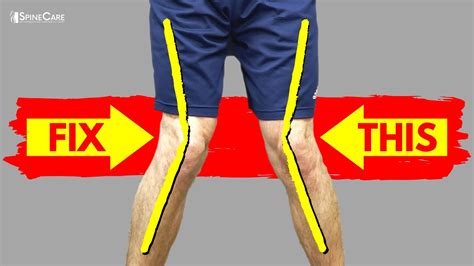 The Best Ways To Fix Knock Knees At Home Safer Pain Management
