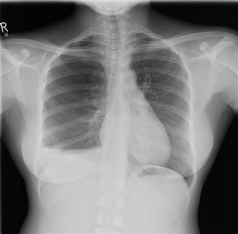Chest X Ray Showing A Right Hydropneumothorax With Clear Lung Fields