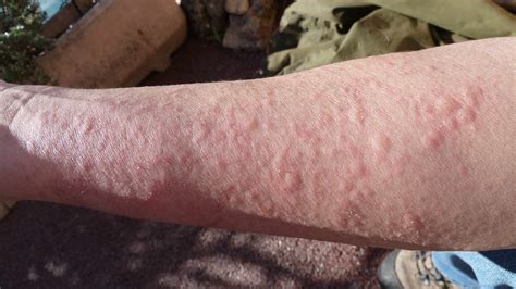 A rash is essentially inflammation in the skin that can be caused by either an external exposure or an internal factor, says joshua zeichner, m.d., director of cosmetic and clinical research in dermatology at mount sinai. Skin Rashes | Atlanta, GA