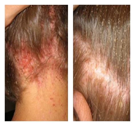 Nuisance Related To Lice A Scalp Infection Caused By Head Lice B