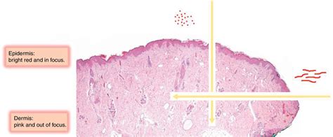 Vascular Patterns In Dermoscopy Actas Dermo Sifiliográficas