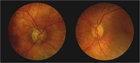 Glaucomatous Type Cupping Caused By Internal Carotid Artery Compression