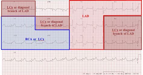 This can lead to a heart attack and possibly death. ECG localisation of coronary artery territories - Deranged ...