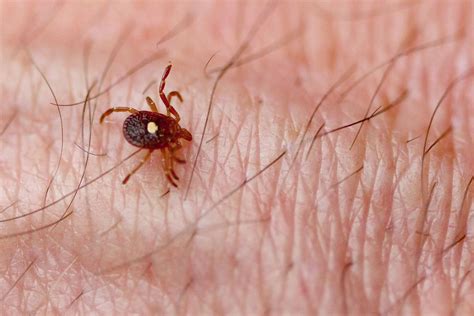 Tick Related Meat Allergies Are On The Rise — Yet Most Doctors Dont