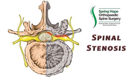 Spinal Stenosis Orthopaedic Spine Surgery Singapore