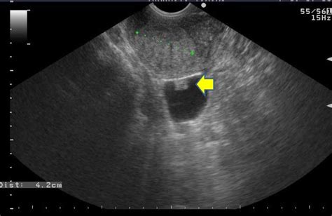 A Transvaginal Ultrasound Examination Shows A Cystic Lesion With