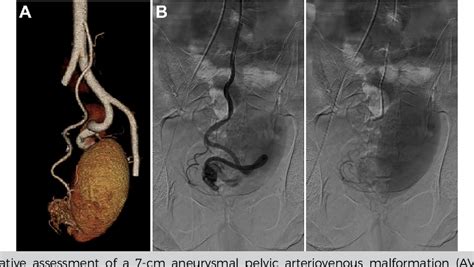 Figure 1 From Endovascular Management Of A Pelvic Arteriovenous