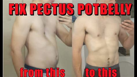 How To Fix Pectus Excavatum Potbelly Without Surgery Youtube