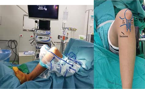 Anatomic Single Bundle Acl Reconstruction With Remnant Augmentation