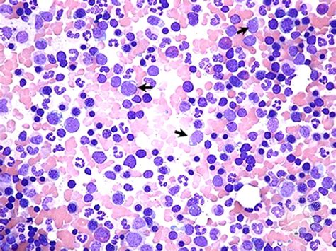 Relapsed Precursor B Cell Acute Lymphoblastic Leukemia 1