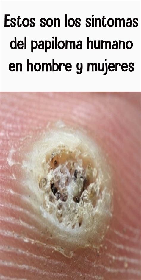 Top Imagenes Del Virus Del Papiloma Humano En Hombres Hot Sex Picture