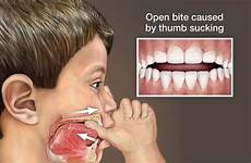pacifier denti dito suzione habit lingua bocca malocclusioni possono corretta jaw pediatric pacifiers precoce orale posizione biting anesthesia orthodontics