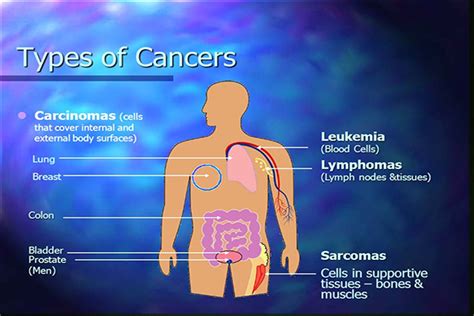 How To Prevent The Rise In Different Types Of Cancers Among Humans Naturally