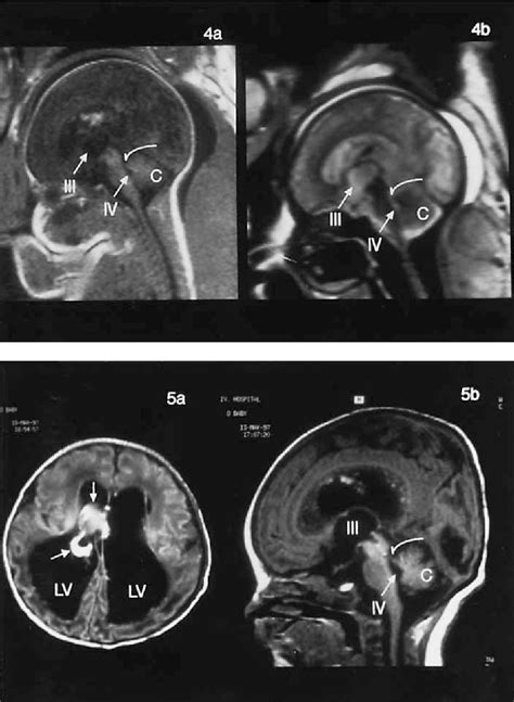 Figure 3 From Fetal Hydrocephalus Secondary To Intraventricular
