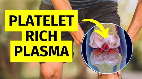 prp injections for knee arthritis what you need to know youtube